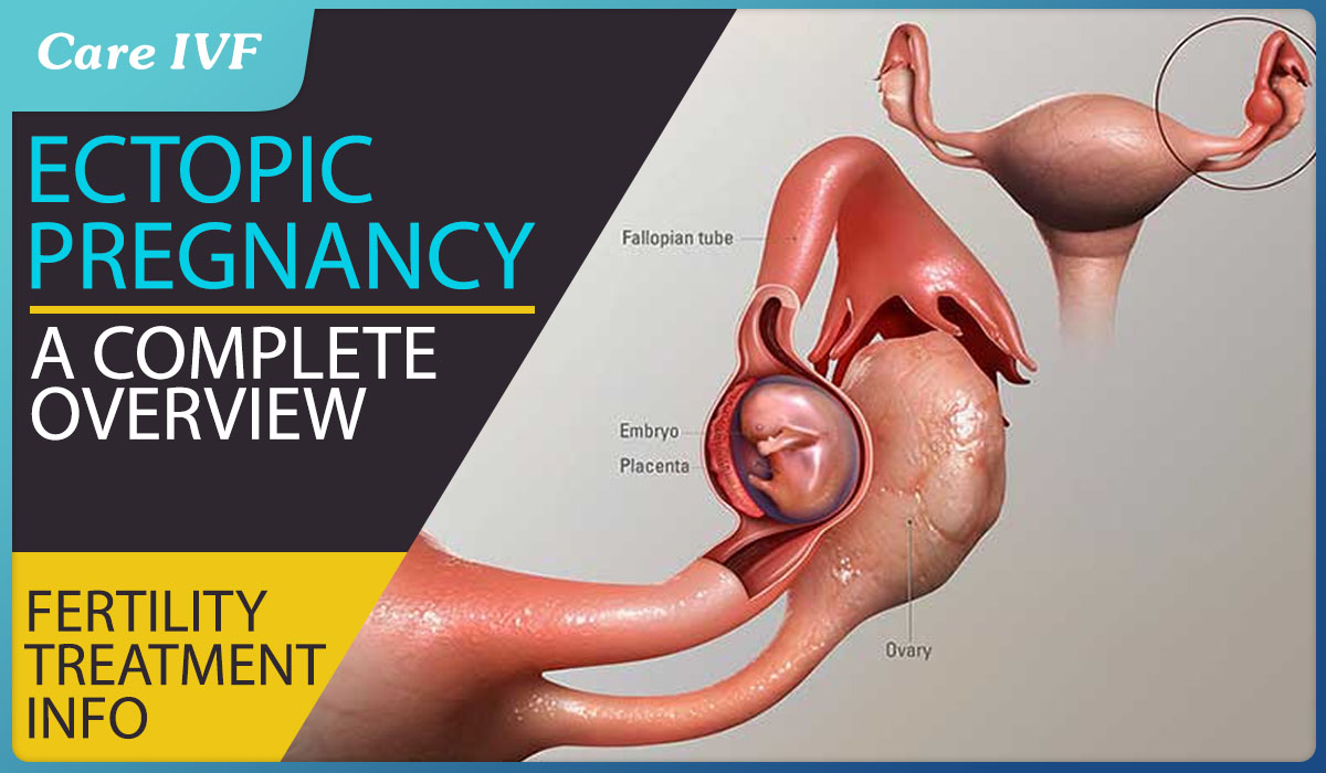 Ectopic Pregnancy - Symptoms, Risk Factors, Causes, Treatment