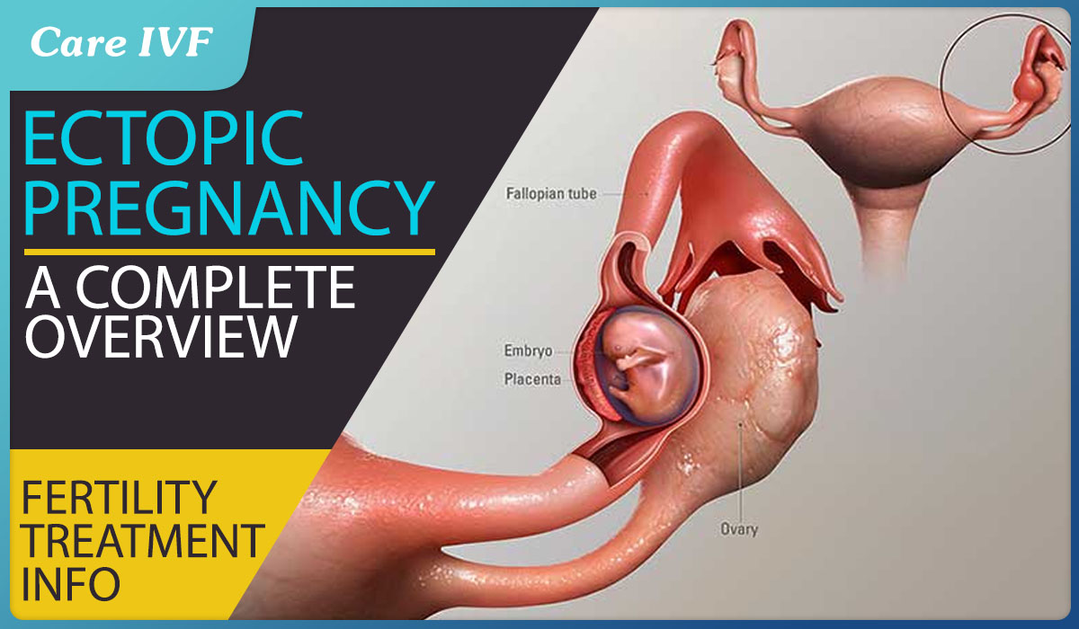 Ectopic Pregnancy: Causes, Symptoms & Treatments