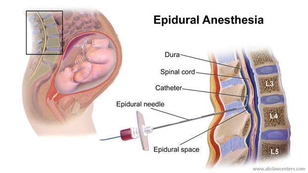 spinal-anaesthesia