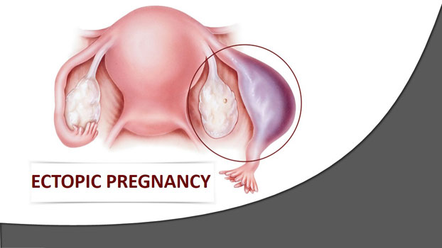 ectopic-pregnancy-counseling-under-best-fertility-clinic
